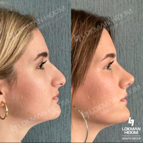 Septoplasty Before / After photo